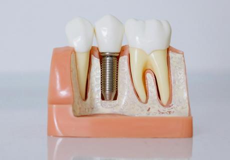 All About Diamond Teeth: Advantage – Procedure – Before After Image
