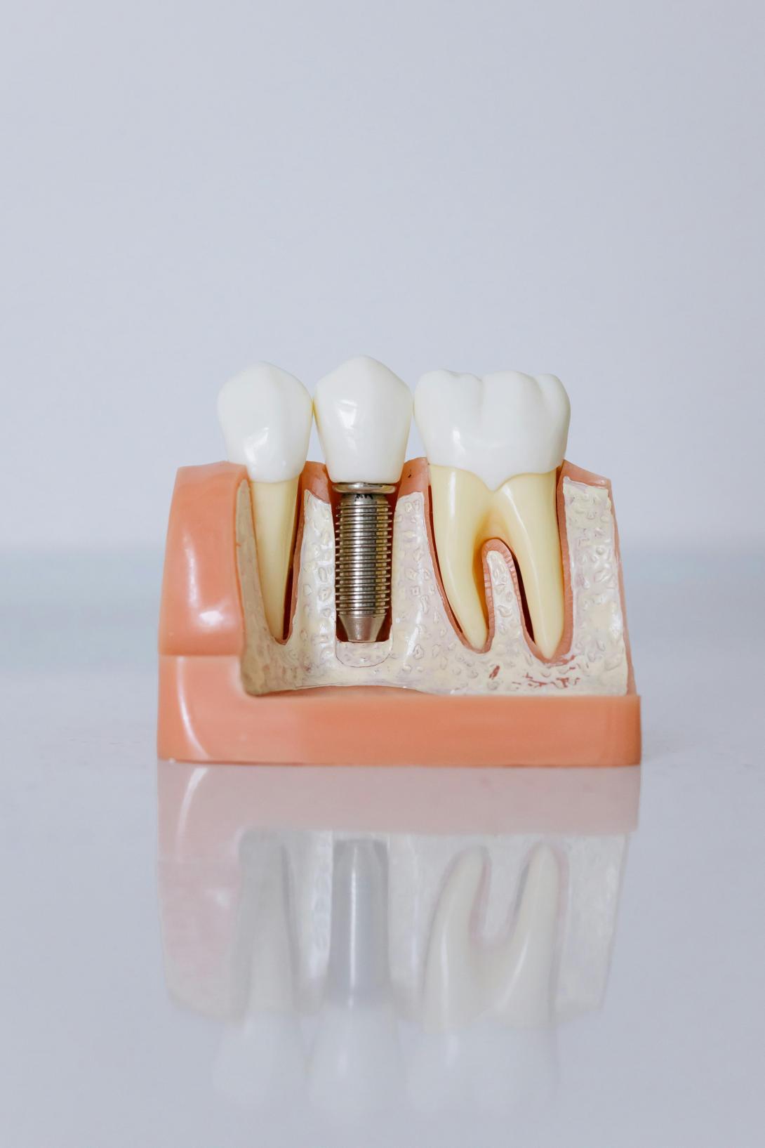 All About Diamond Teeth: Advantage – Procedure – Before After Image